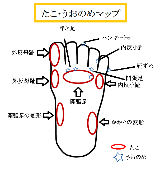 たこ・うおのめにはできる原因があります！